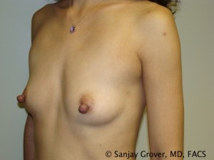 Breast Augmentation Before and After 159 | Sanjay Grover MD FACS