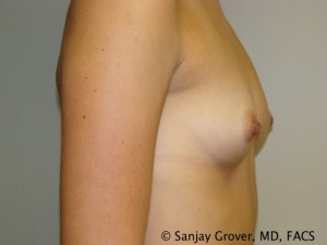 Breast Augmentation Before and After 161 | Sanjay Grover MD FACS