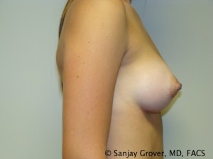 Breast Augmentation Before and After 161 | Sanjay Grover MD FACS