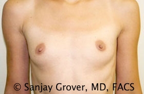 Breast Augmentation Before and After 113 | Sanjay Grover MD FACS