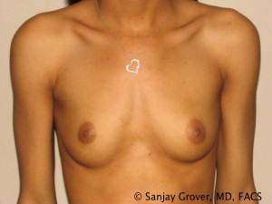 Breast Augmentation Before and After 53 | Sanjay Grover MD FACS
