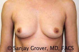 Breast Augmentation Before and After 276 | Sanjay Grover MD FACS