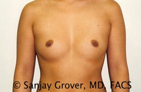 Breast Augmentation Before and After 10 | Sanjay Grover MD FACS
