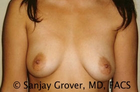 Breast Augmentation Before and After 62 | Sanjay Grover MD FACS