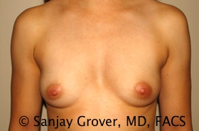 Breast Augmentation Before and After 55 | Sanjay Grover MD FACS