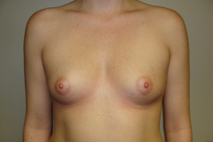 Breast Augmentation Before and After 151 | Sanjay Grover MD FACS