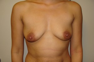 Breast Augmentation Before and After 216 | Sanjay Grover MD FACS