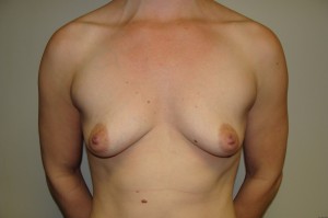 Breast Augmentation Before and After 24 | Sanjay Grover MD FACS