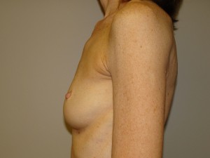 Breast Augmentation Before and After 200 | Sanjay Grover MD FACS