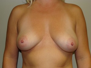 Breast Augmentation Before and After 145 | Sanjay Grover MD FACS