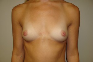 Breast Augmentation Before and After 20 | Sanjay Grover MD FACS
