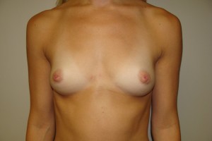 Breast Augmentation Before and After 263 | Sanjay Grover MD FACS