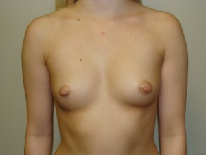 Breast Augmentation Before and After 160 | Sanjay Grover MD FACS