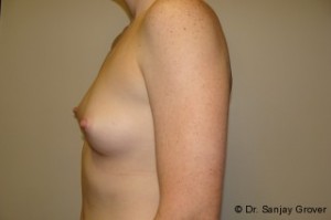 Breast Augmentation Before and After 219 | Sanjay Grover MD FACS