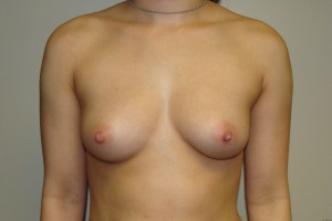 Breast Augmentation Before and After 284 | Sanjay Grover MD FACS