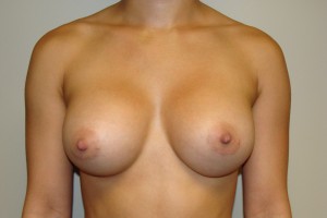 Breast Augmentation Before and After 223 | Sanjay Grover MD FACS