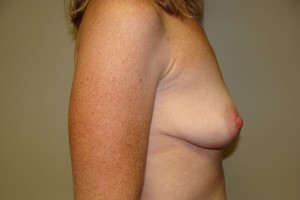 Breast Augmentation Before and After 225 | Sanjay Grover MD FACS