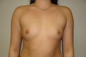 Breast Augmentation Before and After 269 | Sanjay Grover MD FACS