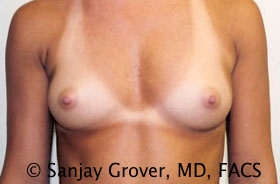Breast Augmentation Before and After 46 | Sanjay Grover MD FACS
