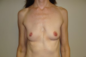 Breast Augmentation Before and After 117 | Sanjay Grover MD FACS