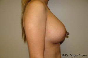 Breast Augmentation Before and After 242 | Sanjay Grover MD FACS