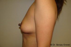 Breast Augmentation Before and After 242 | Sanjay Grover MD FACS