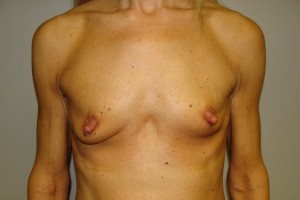 Breast Augmentation Before and After 219 | Sanjay Grover MD FACS