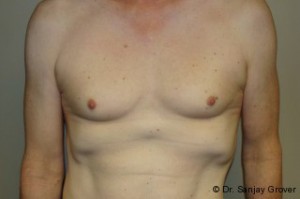 Breast Augmentation Before and After 125 | Sanjay Grover MD FACS