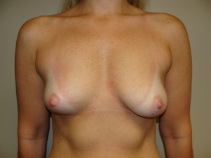 Breast Augmentation Before and After 51 | Sanjay Grover MD FACS