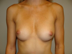 Breast Augmentation Before and After 73 | Sanjay Grover MD FACS