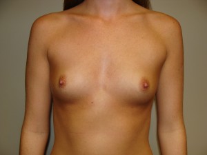 Breast Augmentation Before and After 292 | Sanjay Grover MD FACS