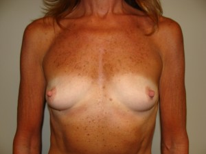 Breast Augmentation Before and After 311 | Sanjay Grover MD FACS