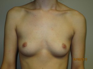 Breast Augmentation Before and After 133 | Sanjay Grover MD FACS