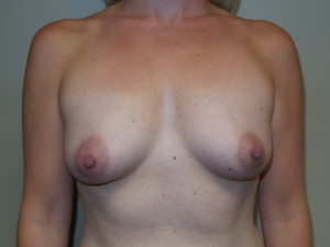 Breast Augmentation Before and After 196 | Sanjay Grover MD FACS