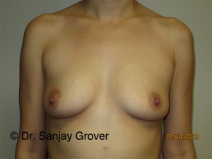 Breast Augmentation Before and After 303 | Sanjay Grover MD FACS