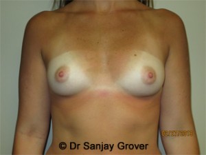 Breast Augmentation Before and After 192 | Sanjay Grover MD FACS