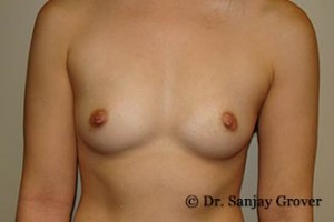 Breast Augmentation Before and After 105 | Sanjay Grover MD FACS