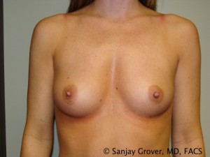 Breast Augmentation Before and After 264 | Sanjay Grover MD FACS
