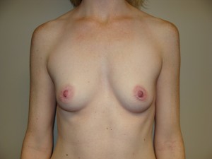 Breast Augmentation Before and After 157 | Sanjay Grover MD FACS