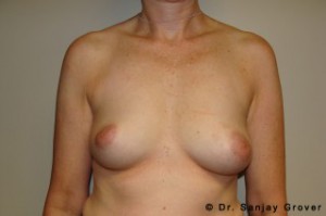 Breast Augmentation Before and After 238 | Sanjay Grover MD FACS
