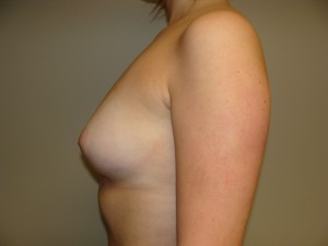 Breast Augmentation Before and After 298 | Sanjay Grover MD FACS