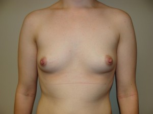 Breast Augmentation Before and After 45 | Sanjay Grover MD FACS