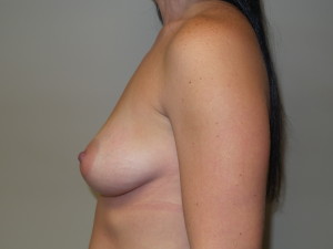 Breast Augmentation Before and After 30 | Sanjay Grover MD FACS