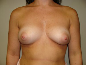 Breast Augmentation Before and After 53 | Sanjay Grover MD FACS