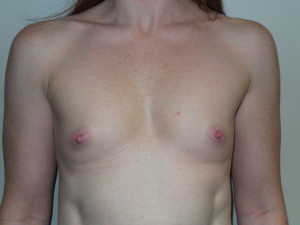 Breast Augmentation Before and After 111 | Sanjay Grover MD FACS