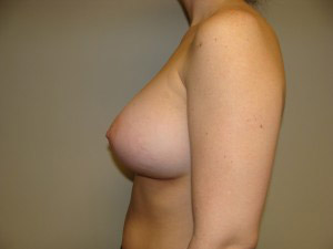 Breast Augmentation Before and After 305 | Sanjay Grover MD FACS