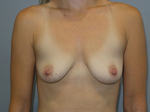 Breast Augmentation Before and After 273 | Sanjay Grover MD FACS