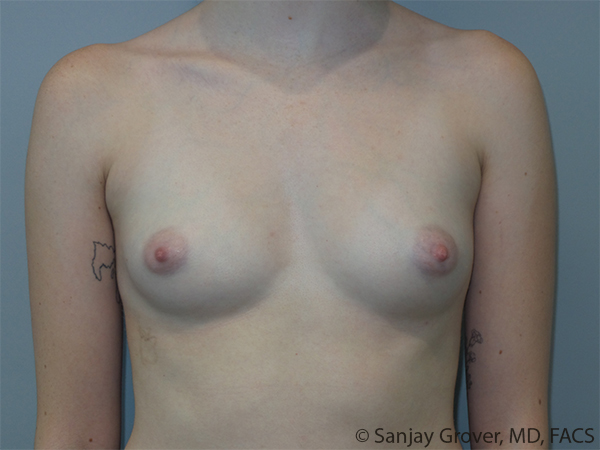 Breast Augmentation Before and After 246 | Sanjay Grover MD FACS