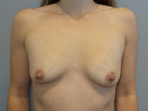 Breast Augmentation Before and After 281 | Sanjay Grover MD FACS