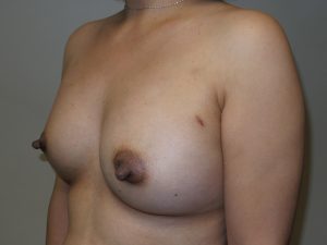 Breast Augmentation Before and After 32 | Sanjay Grover MD FACS